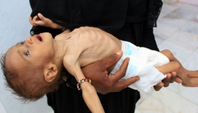 الصحة العالمية تعلن علاج 18 ألف طفل يمني من سوء التغذية الوخيم